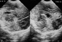 Ecografía cerebral trasnsfontanelar.
