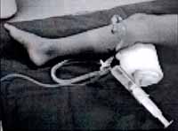 Médula ósea hacia una jeringa