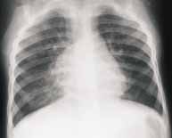 Proyección AP de tórax con neumonía viral  Proyección AP de tórax con neumonía viral