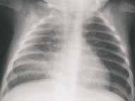 Paciente lactante menor con cuadro de infección viral inicial   Paciente lactante menor con cuadro de infección viral inicial