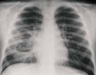 Consolidación neumónica de la región basal derecha  Consolidación neumónica de la región basal derecha