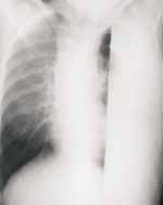 Proyección de tórax en decúbito lateral izquierdo  Proyección de tórax en decúbito lateral izquierdo