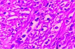 La inmunoperoxidasa mostró actina muscular positiva La inmunoperoxidasa mostró actina muscular positiva