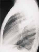 Proyección lateral de tórax en paciente con neumonía viraL