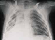 Imagen típica de atelectasia parcial del hemitórax derecho