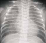 Paciente lactante menor con cuadro de infección respiratoria viral