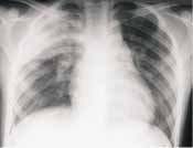 Proyección AP de tórax con consolidación neumónica Proyección AP de tórax con consolidación neumónica
