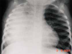 Paciente lactante de sexo femenino con neumonía Paciente lactante de sexo femenino con neumonía