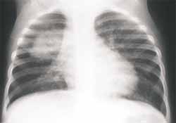 Proyección Ap de tórax en la cual existe neumonía Proyección Ap de tórax en la cual existe neumonía