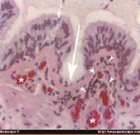 Lesiones histológicas en epitelio bronquial por infección viral Lesiones histológicas en epitelio bronquial por infección viral