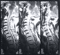 Resonancia Magnética de columna cervical  Resonancia Magnética de columna cervical