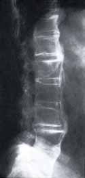 Radiografía Simple de Columna Lumbar Radiografía Simple de Columna Lumbar
