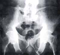Radiografía de Pelvis, Proyección AP Radiografía de Pelvis, Proyección AP
