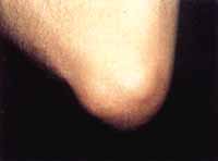 Nódulos subcutáneos juxta articulares de 2 x 3 cm de tamaño y consistencia dura en los codos Nódulos subcutáneos juxta articulares de 2 x 3 cm de tamaño y consistencia dura en los codos