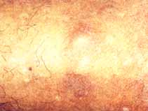 Nódulo de consistencia dura: Area de placas escleróticas de consistencia dura. Pérdida del pelo terminal en estas zonas. Nódulo de consistencia dura: Area de placas escleróticas de consistencia dura. Pérdida del pelo terminal en estas zonas.