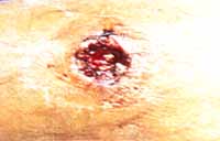 Acercamiento de la lesión descrita en la figura 3. Acercamiento de la lesión descrita en la figura 3.