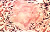 Material amorfo en la dermis profunda Material amorfo en la dermis profunda