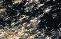 Frotis de material blanquecino que muestra cristales en forma de agujas con birrefringencia negativa intensa. Frotis de material blanquecino que muestra cristales en forma de agujas con birrefringencia negativa intensa.