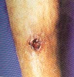 Lesión ulcerada en cara externa de pierna derecha secundaria a paniculitis por gota  Lesión ulcerada en cara externa de pierna derecha secundaria a paniculitis por gota