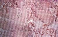 Biopsia de piel de lesión ulcerada Biopsia de piel de lesión ulcerada