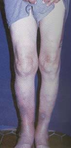 Se aprecian múltiples tofos calcificados a nivel de rodillas y cara anterior de piernas Se aprecian múltiples tofos calcificados a nivel de rodillas y cara anterior de piernas