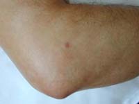 Se aprecia tofo a nivel del codo en paciente con esclerodermia Se aprecia tofo a nivel del codo en paciente con esclerodermia