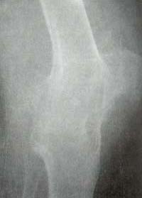 Rodilla. Cambios hipertróficos,  Rodilla. Cambios hipertróficos,