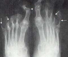 Se aprecian lesiones osteolíticas en las falanges distales del cuarto y quinto dedos de manera bilateral Se aprecian lesiones osteolíticas en las falanges distales del cuarto y quinto dedos de manera bilateral