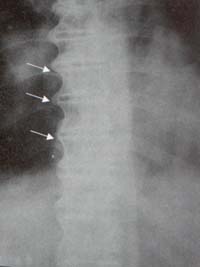 Columna Dorso-lumbar. Columna Dorso-lumbar.
