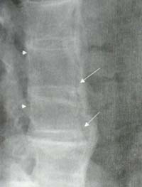Espondilitis anquilosante y DISH. Espondilitis anquilosante y DISH.