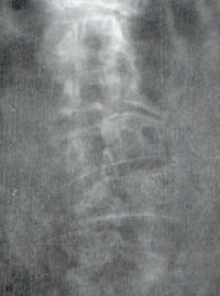 Espondilitis Deformans. Espondilitis Deformans.