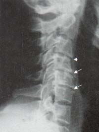 Columna cervical.  Columna cervical.