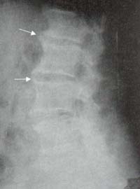 Formaciones esteofíticas anteriores y disminución de todos los espacios intervertebrales Formaciones esteofíticas anteriores y disminución de todos los espacios intervertebrales