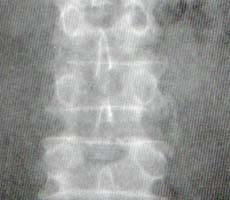 Sindesmofito no marginal en un paciente con Síndrome de Reiter. Sindesmofito no marginal en un paciente con Síndrome de Reiter.