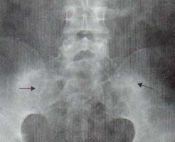 Radiografía de pelvis Radiografía de pelvis