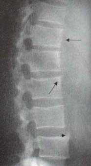 Radiografía de columna lumbar Radiografía de columna lumbar