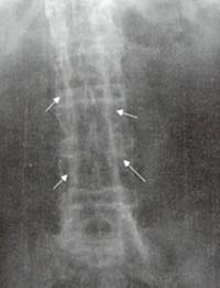 Radiografía de columna lumbar Radiografía de columna lumbar