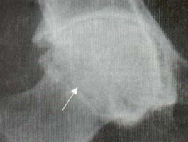 Cadera. Disminución del espacio articular, migración axial de la cabeza femoral Cadera. Disminución del espacio articular, migración axial de la cabeza femoral