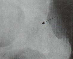 Cadera. Anquilosis completa con formación de puentes óseos entre la cabeza y el iliaco (Flecha) Cadera. Anquilosis completa con formación de puentes óseos entre la cabeza y el iliaco (Flecha)