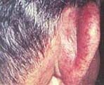 Condritis severa del pabellón auricular en un paciente con GW. Condritis severa del pabellón auricular en un paciente con GW.