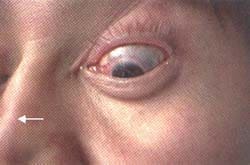 Depresión en el tercio distal de la nariz (flecha), secundaria a lesión del tabique. Depresión en el tercio distal de la nariz (flecha), secundaria a lesión del tabique.