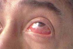 Epiescleritis y escleritis en un paciente con GW. Nótese la congestión de los vasos epiesclerales. Epiescleritis y escleritis en un paciente con GW. Nótese la congestión de los vasos epiesclerales.