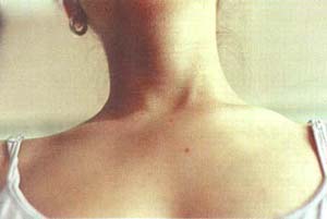 Severa Tumefacción de la región correspondiente a la articulación esternoclavicular izquierda.