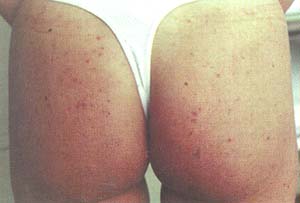 Pustulosis generalizada una semana luego de iniciar el tratamiento. Área glútea. Pustulosis generalizada una semana luego de iniciar el tratamiento. Área glútea.