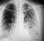 Rx de tórax inicial, con infiltrados alveolares difusos Rx de tórax inicial, con infiltrados alveolares difusos