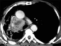 Carcinoma escamolecular Carcinoma escamolecular