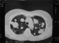 Enfermedad pulmonar metastásica. Enfermedad pulmonar metastásica.