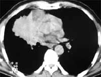 Carcinoma de célula pequeña parahiliar derecho. Carcinoma de célula pequeña parahiliar derecho.