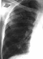 Rx. con múltiples nódulos cavitados de localización subprleural. Rx. y TAC que muestran múltiples nódulos cavitados de localización subprleural.