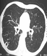 TAC con múltiples nódulos cavitados de localización subprleural TAC con múltiples nódulos cavitados de localización subprleural